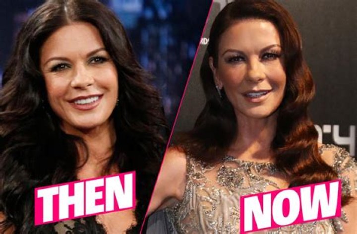 Catherine Zeta Jones Plastic Surgery Disaster Exposed By Top Docs