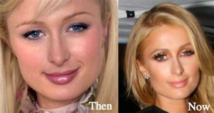 Paris Hilton Nose Job Plastic Surgery Before And After Rhinoplasty