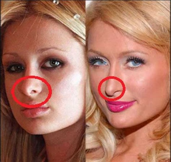 Paris Hilton Plastic Surgery Nose Job and Boob Job Before After